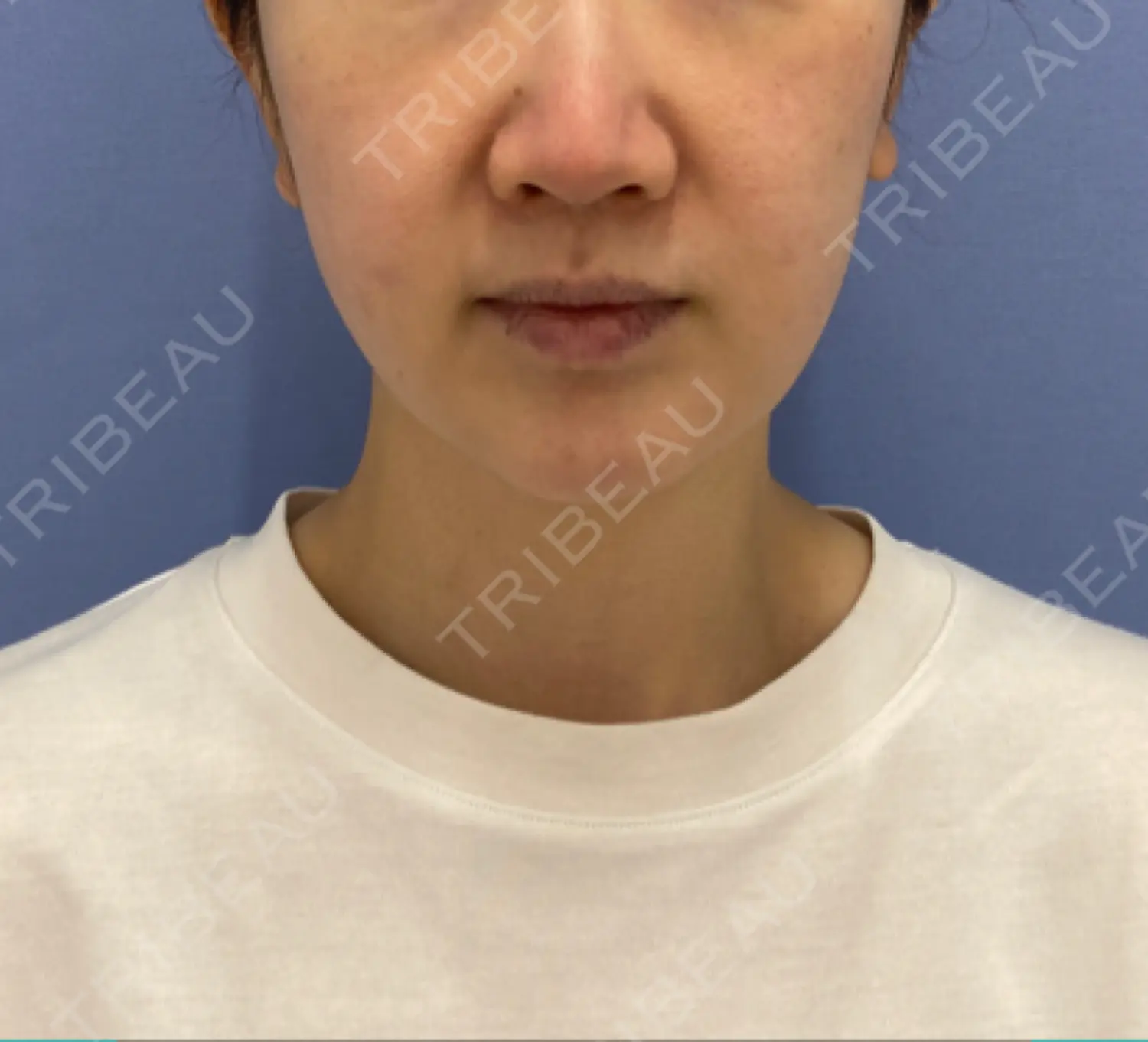 施術前の写真