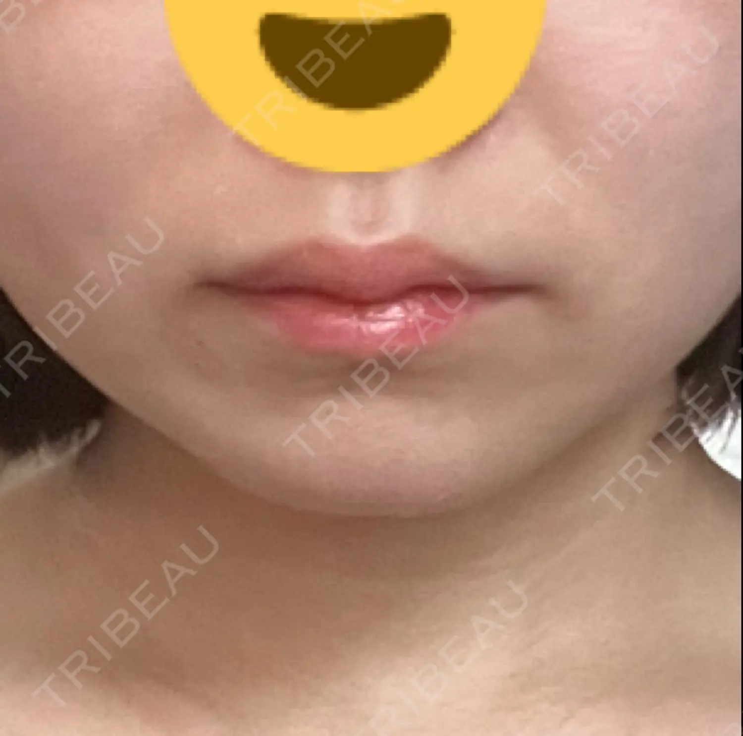 施術前の写真