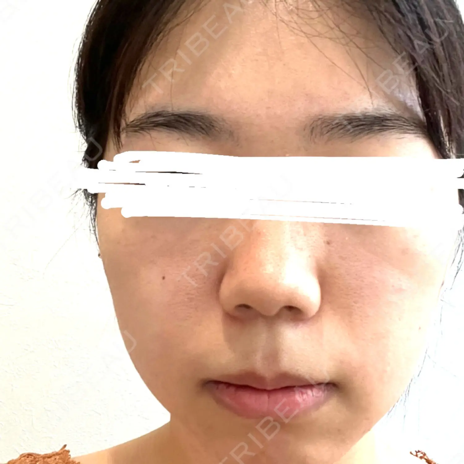 施術前の写真