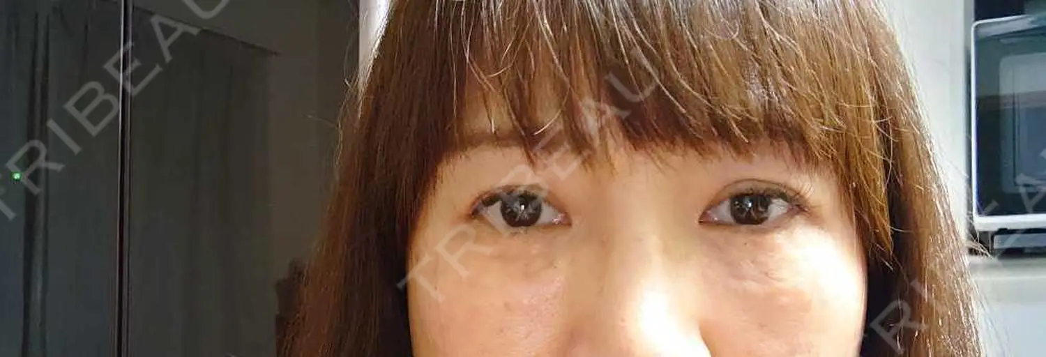 施術前の写真