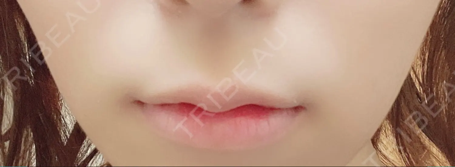 施術前の写真