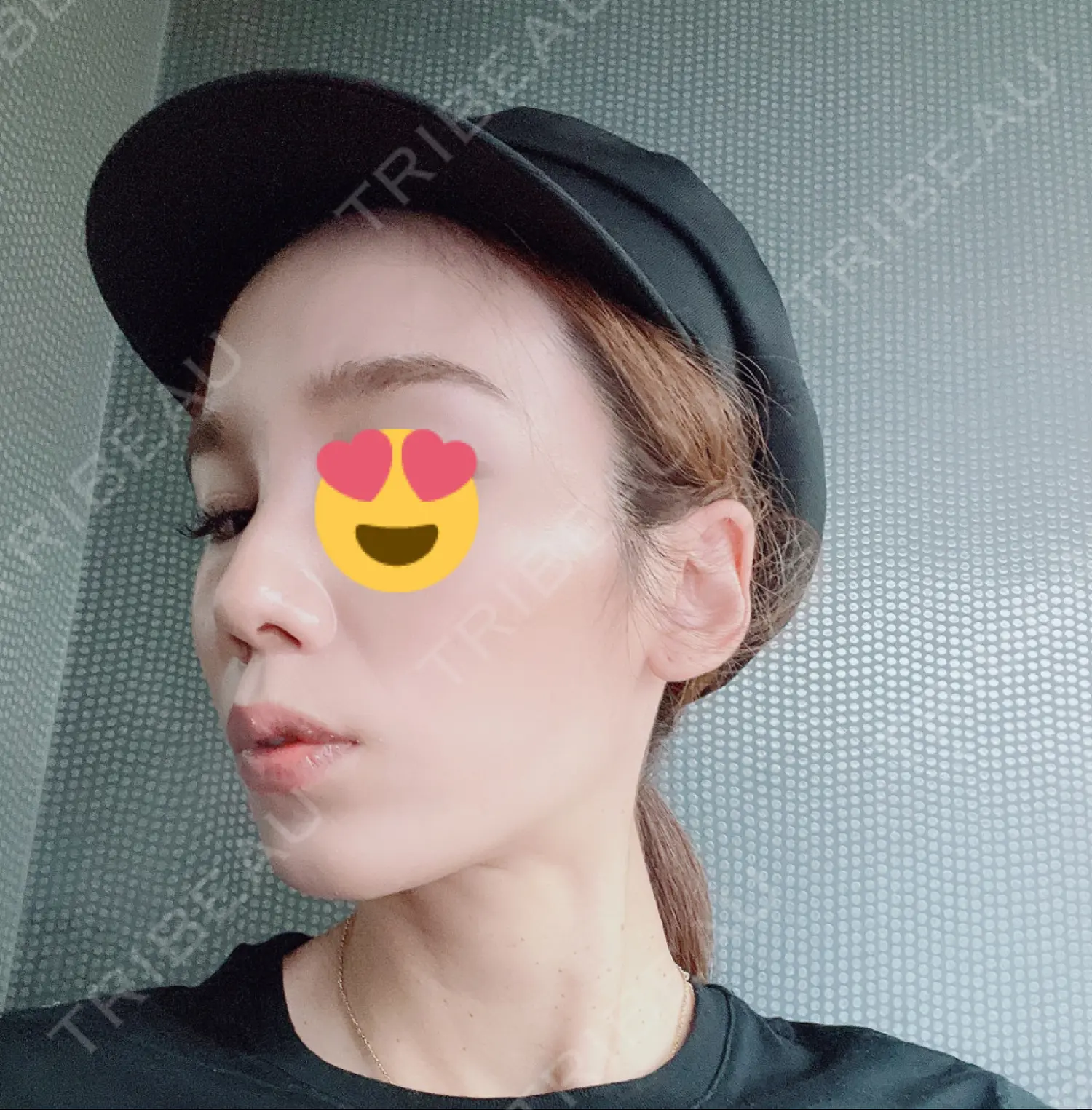 施術前の写真