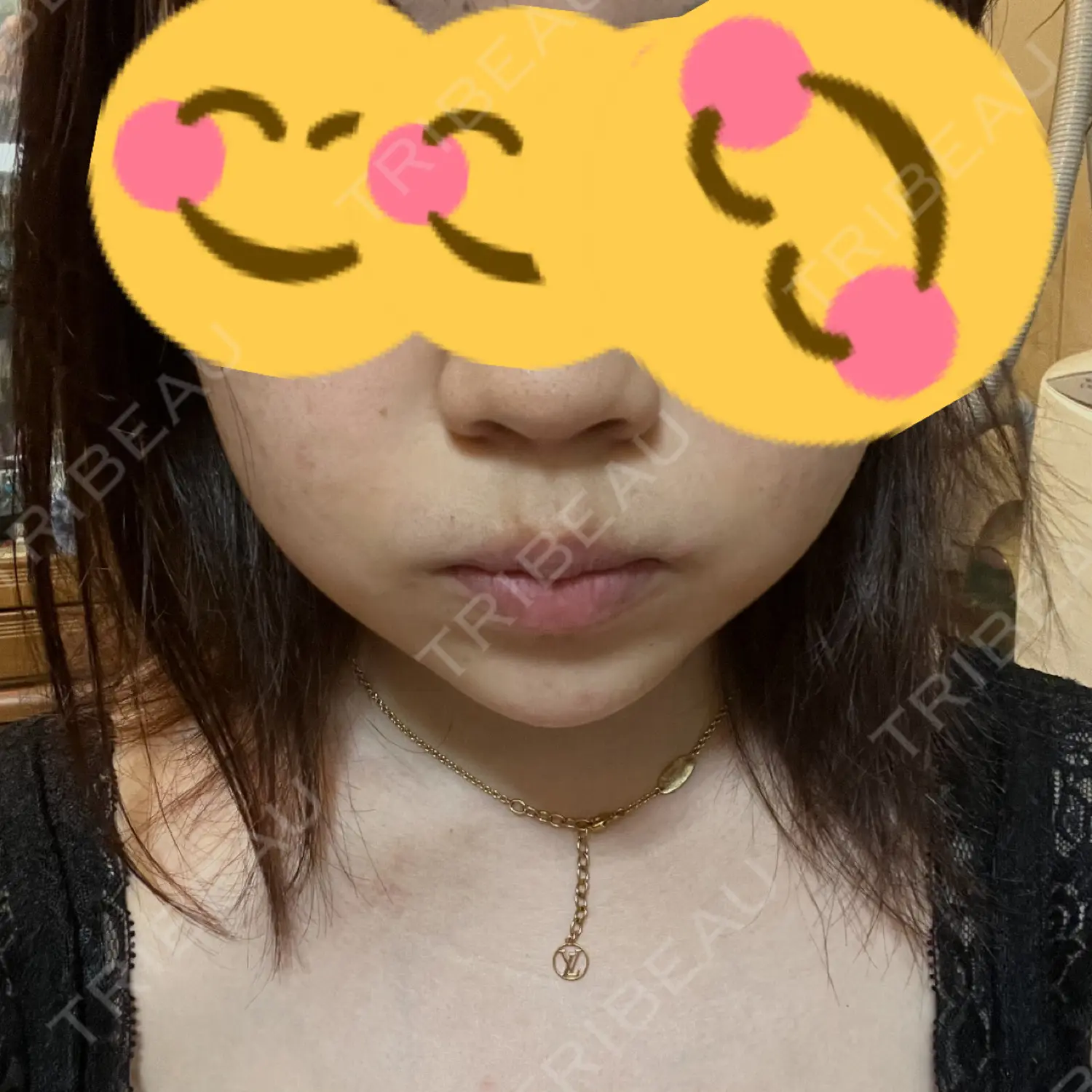 施術前の写真