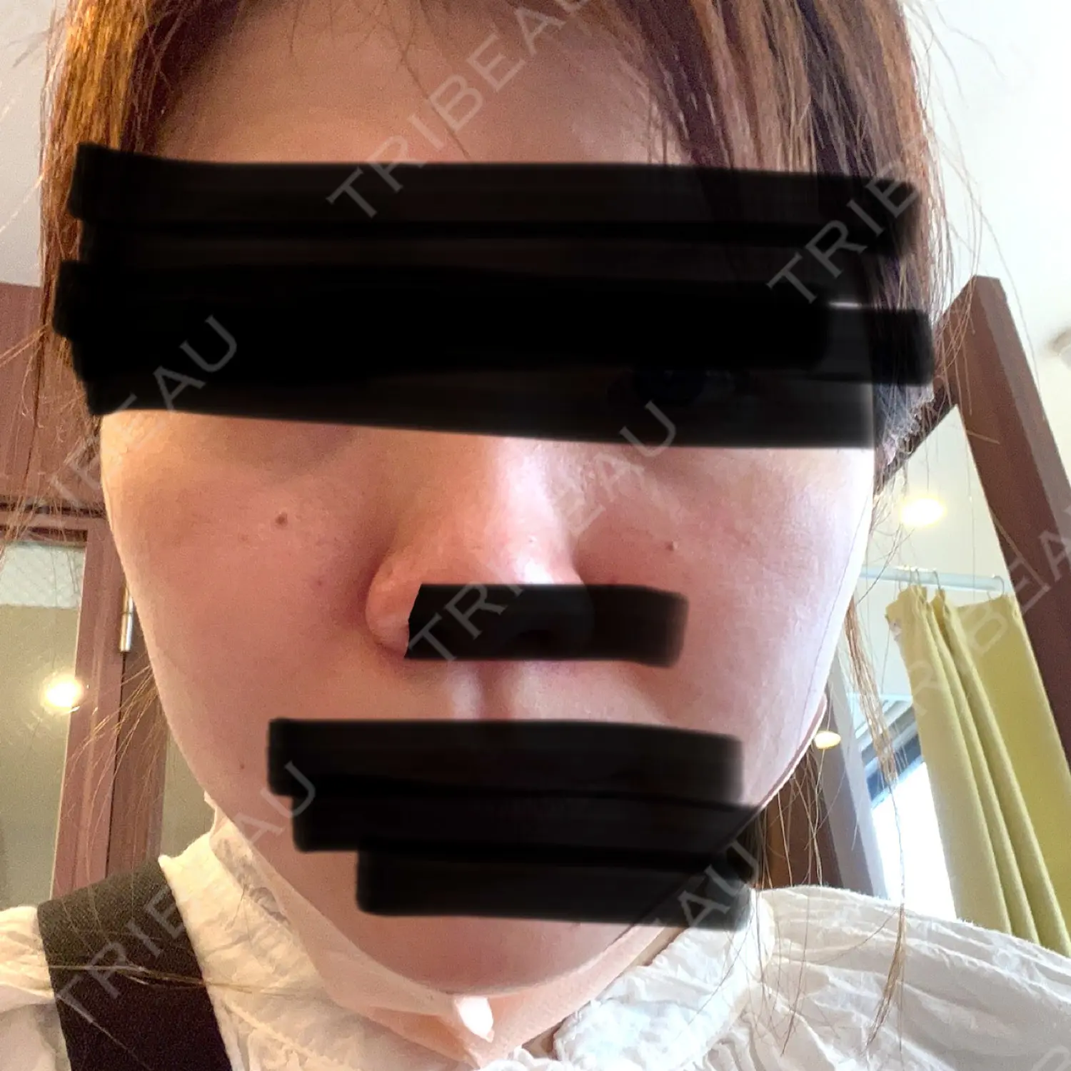 施術前の写真