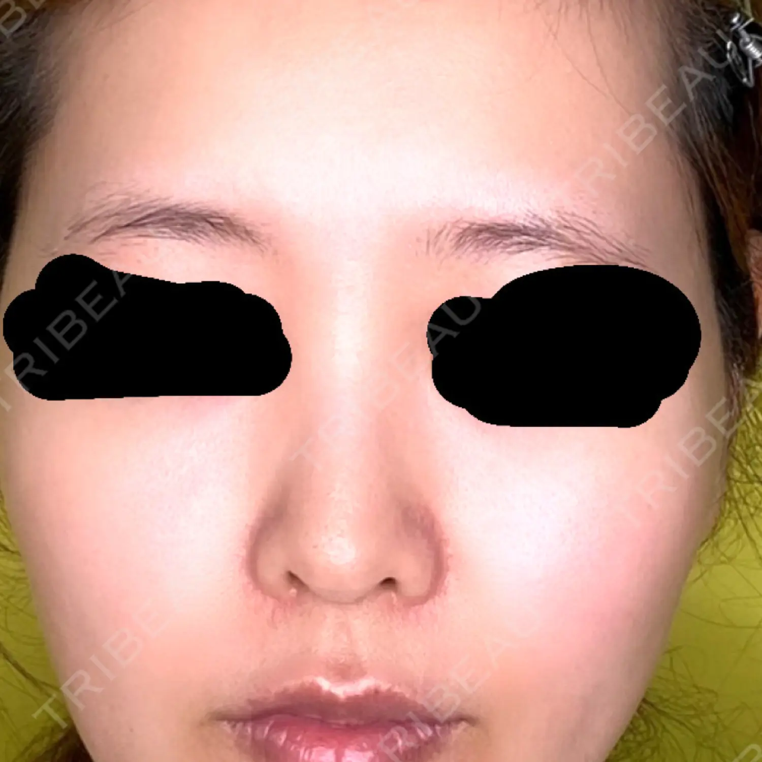 施術前の写真