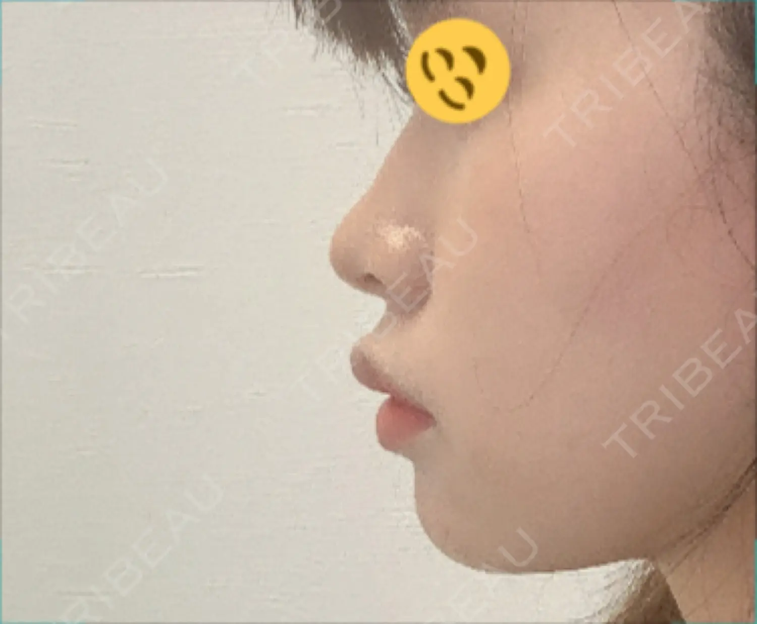 施術前の写真