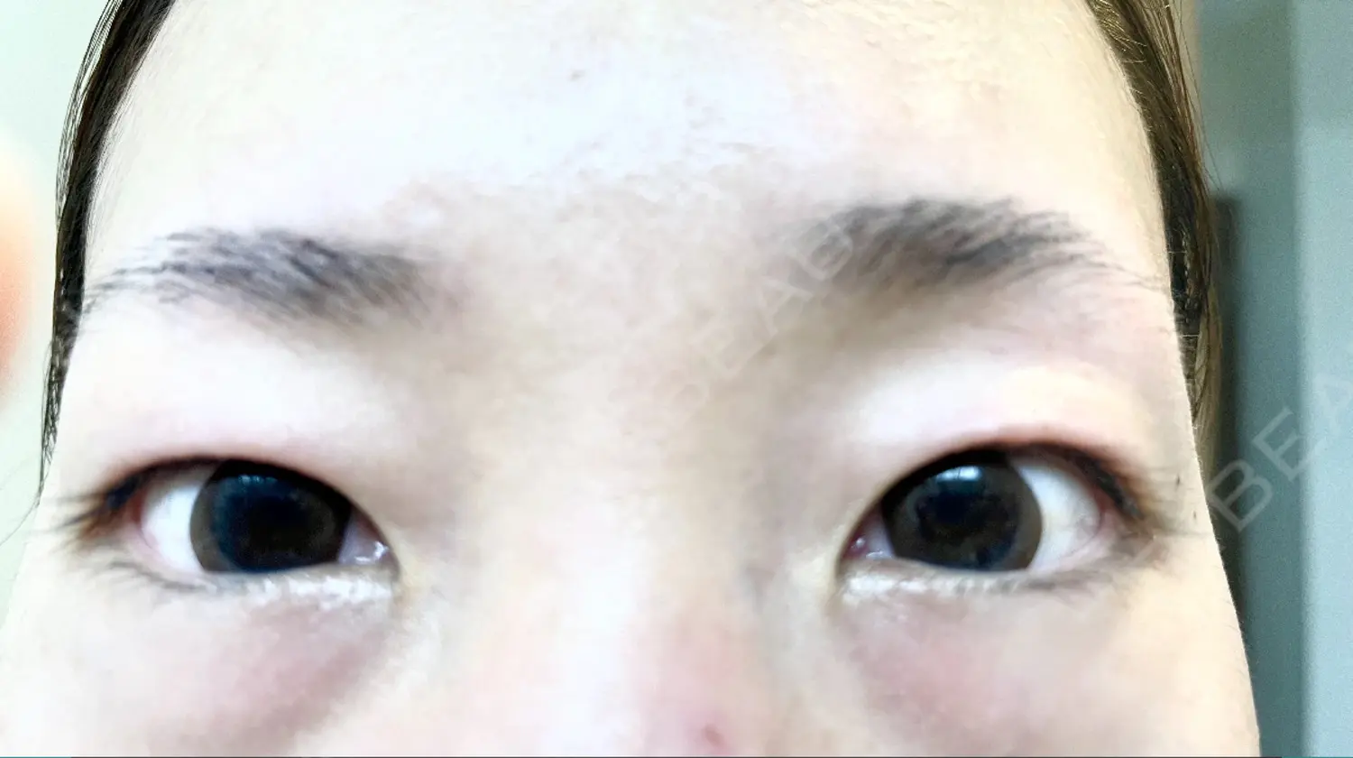 施術前の写真
