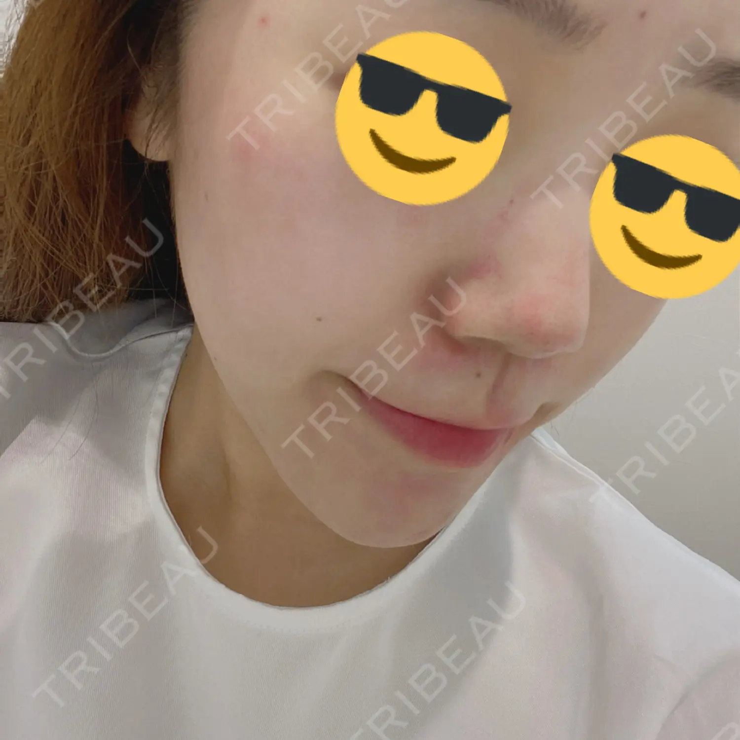 施術前の写真