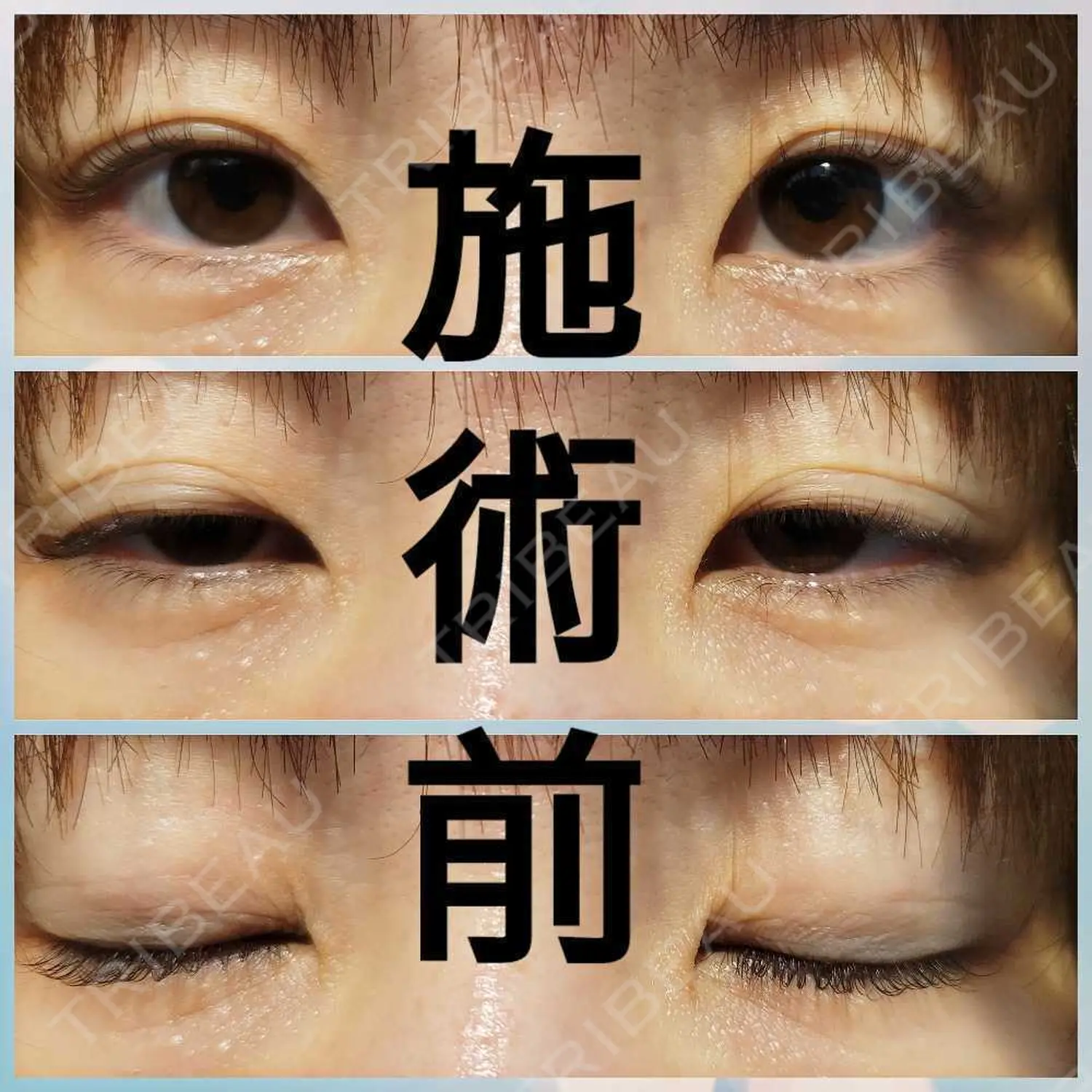 施術前の写真