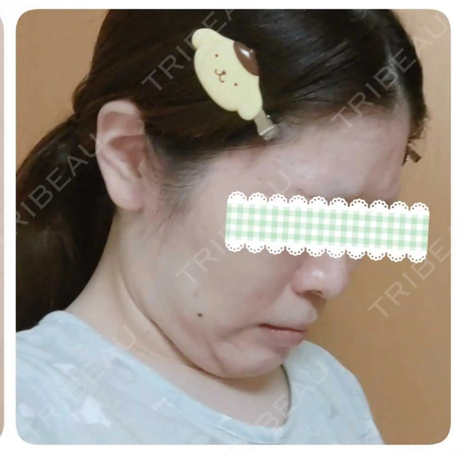 施術前の写真