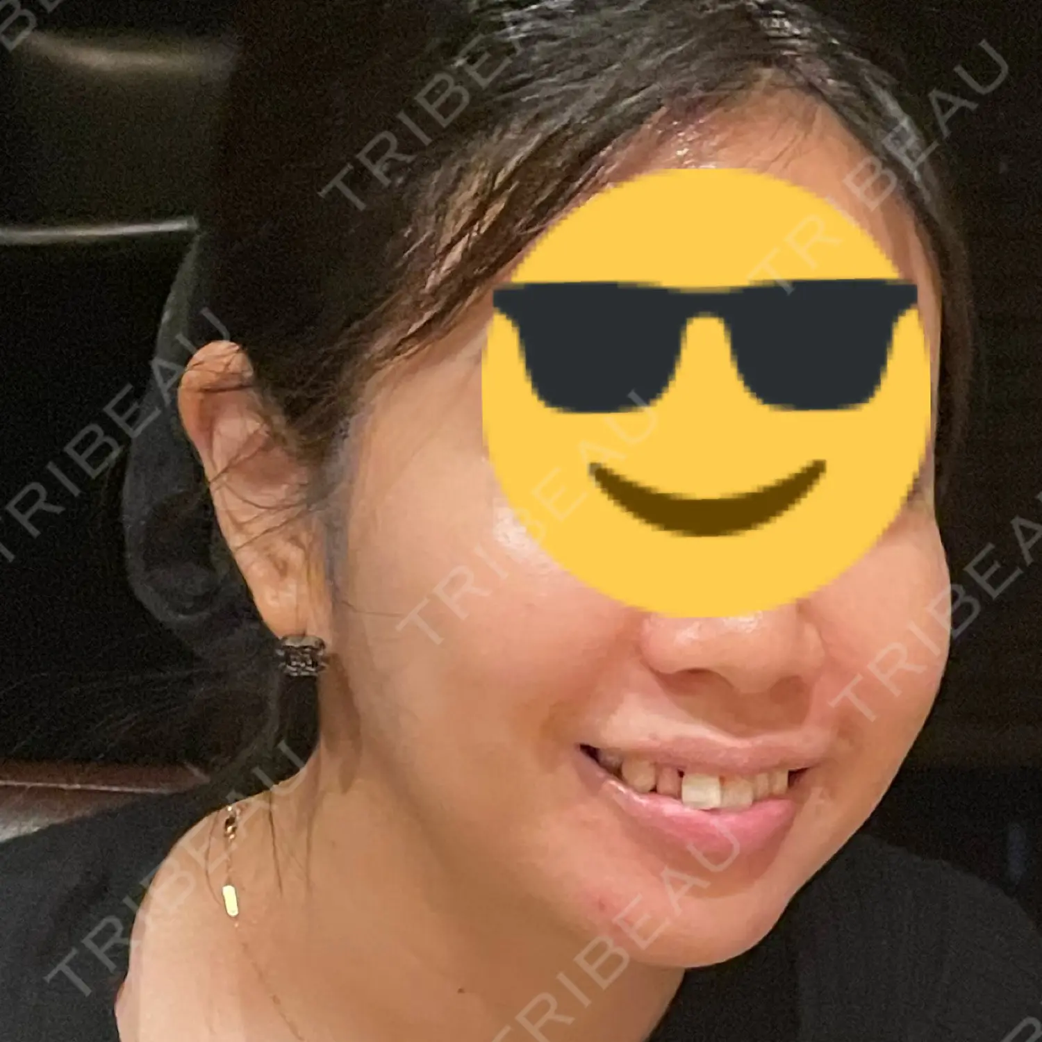 施術前の写真