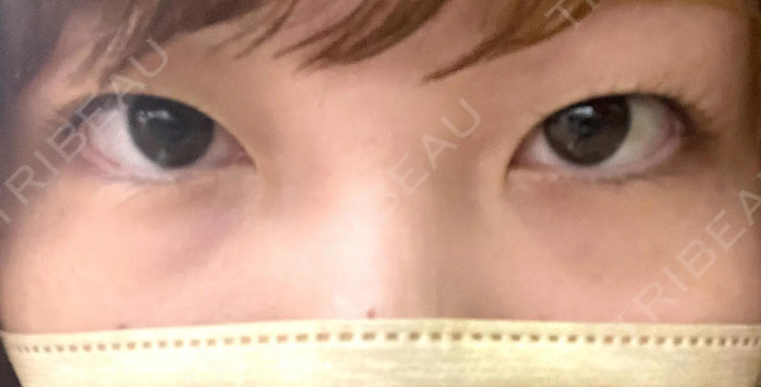 施術前の写真