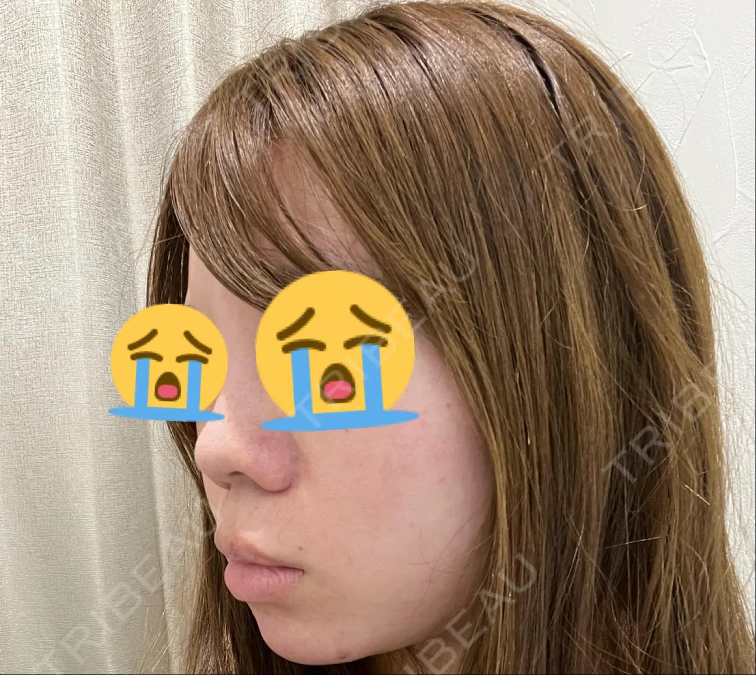 施術前の写真