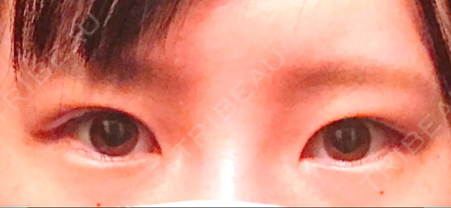 施術前の写真