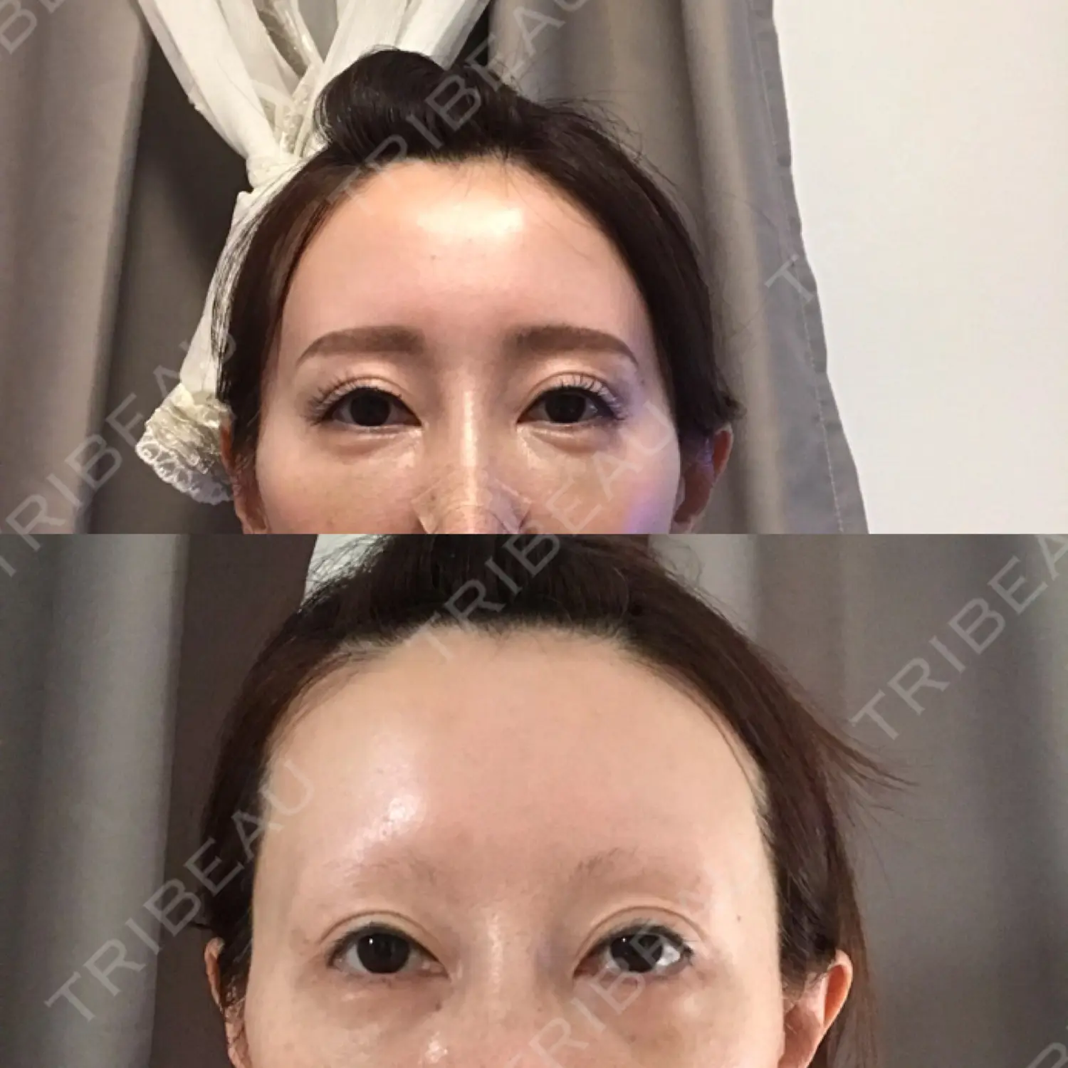 施術前の写真