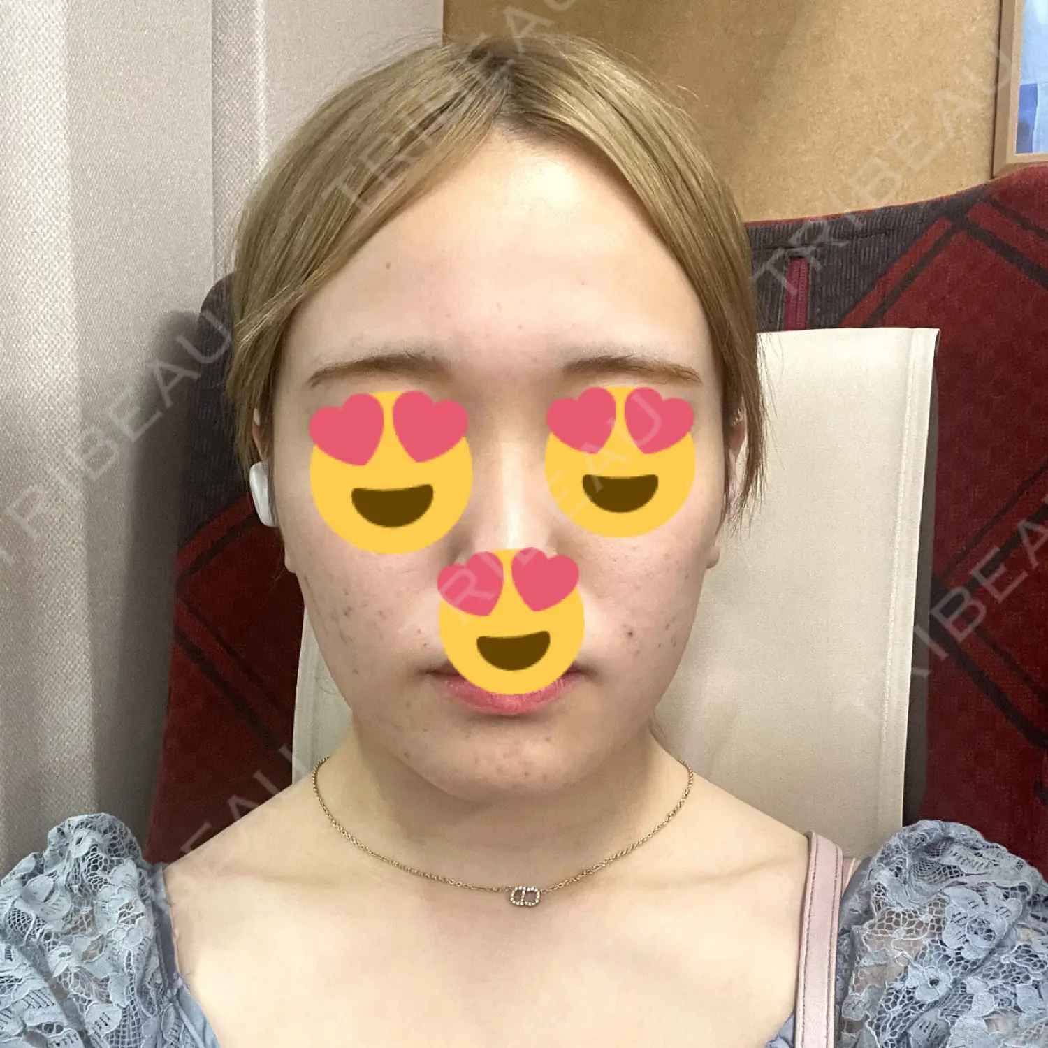 施術前の写真