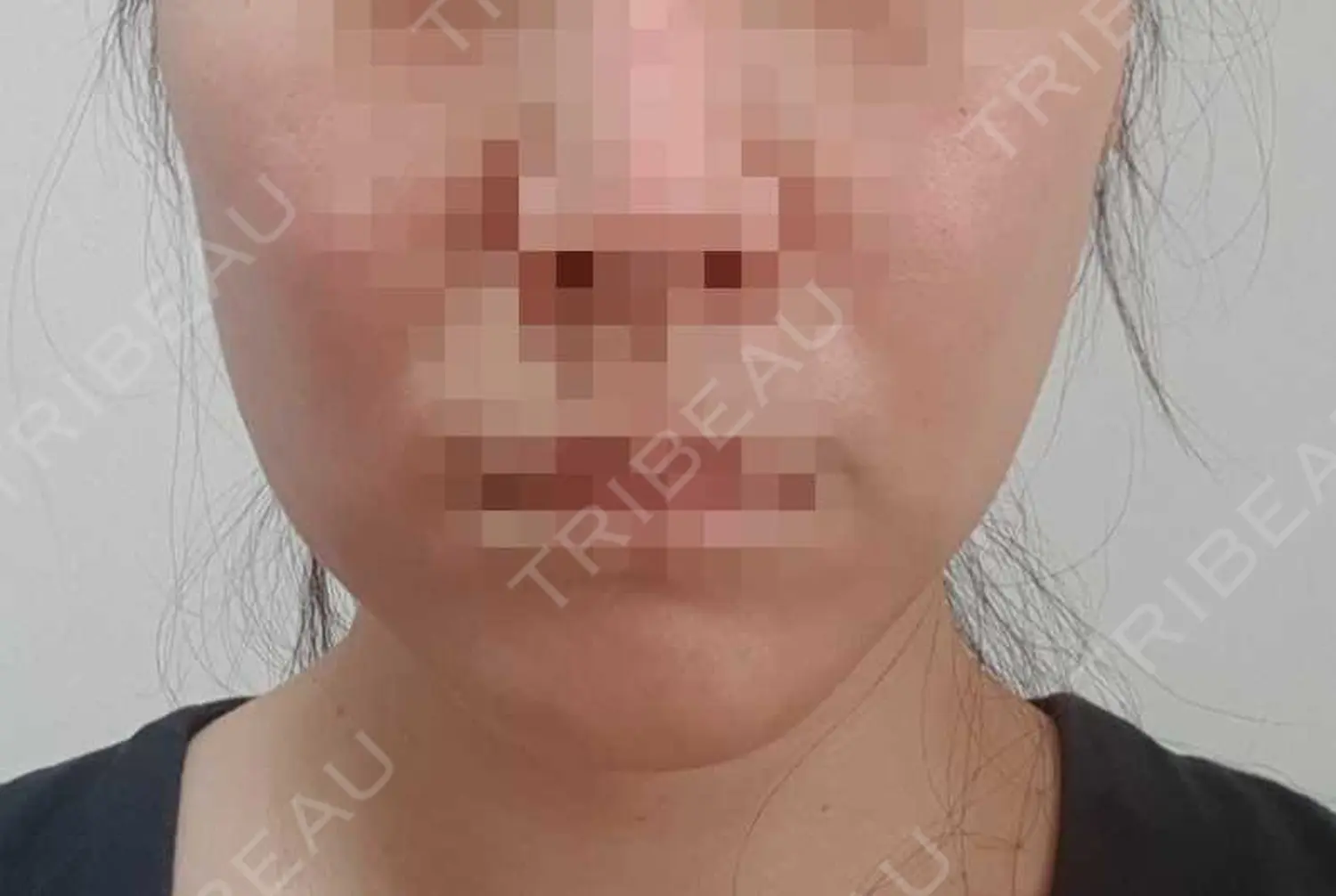 施術前の写真