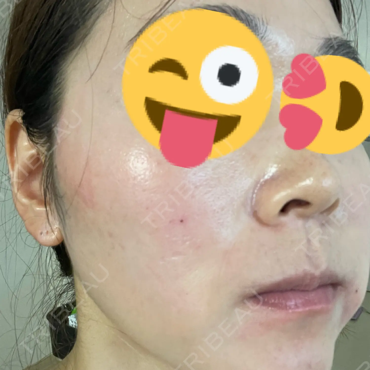 施術前の写真