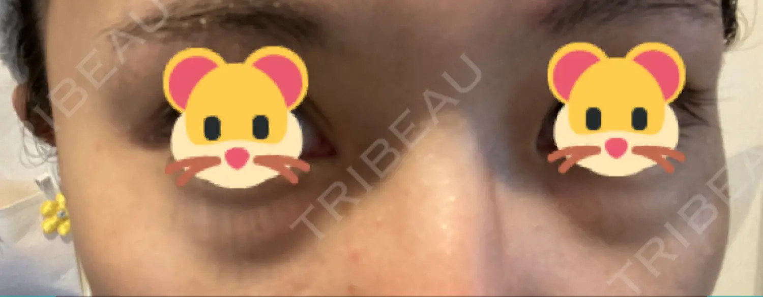 施術前の写真