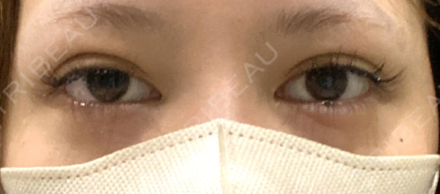 施術前の写真