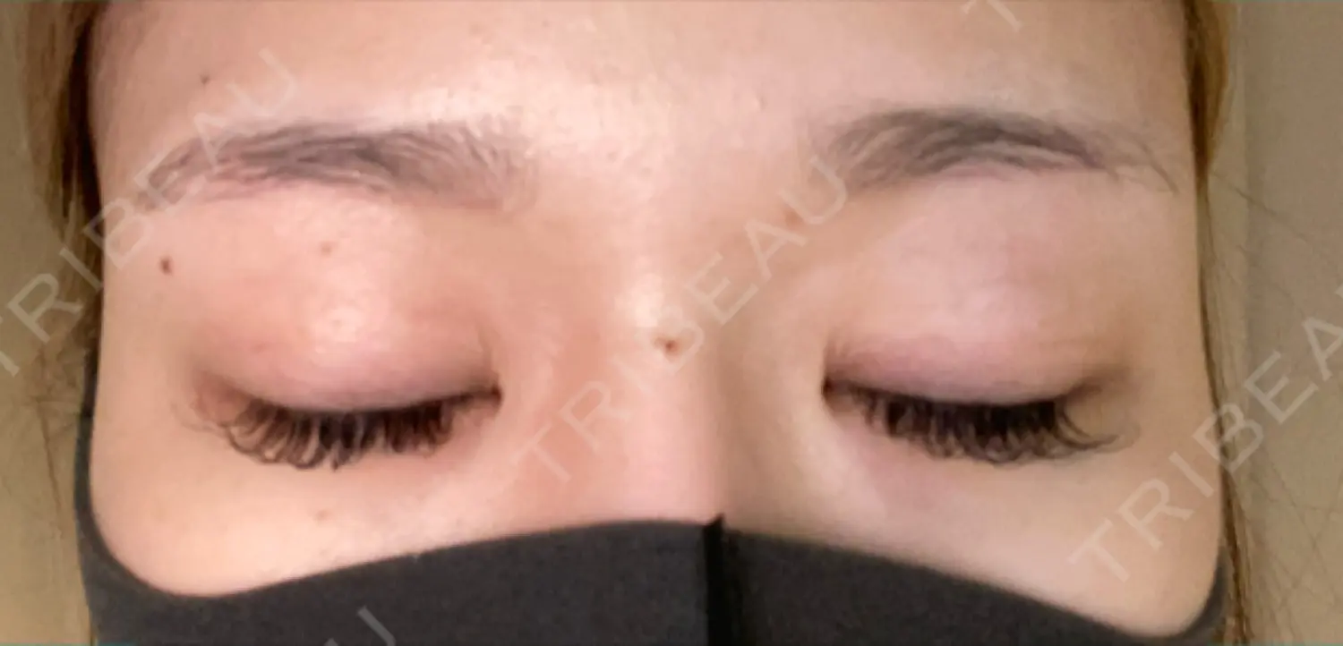 施術前の写真