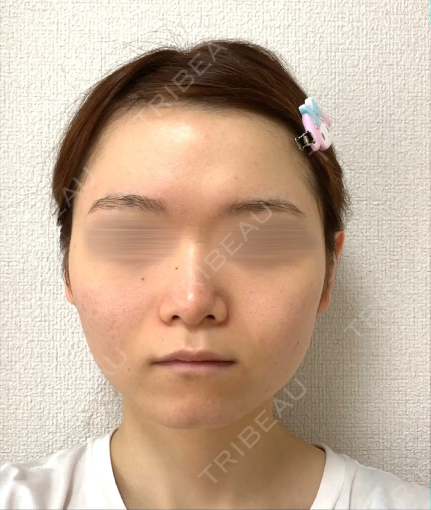 施術前の写真