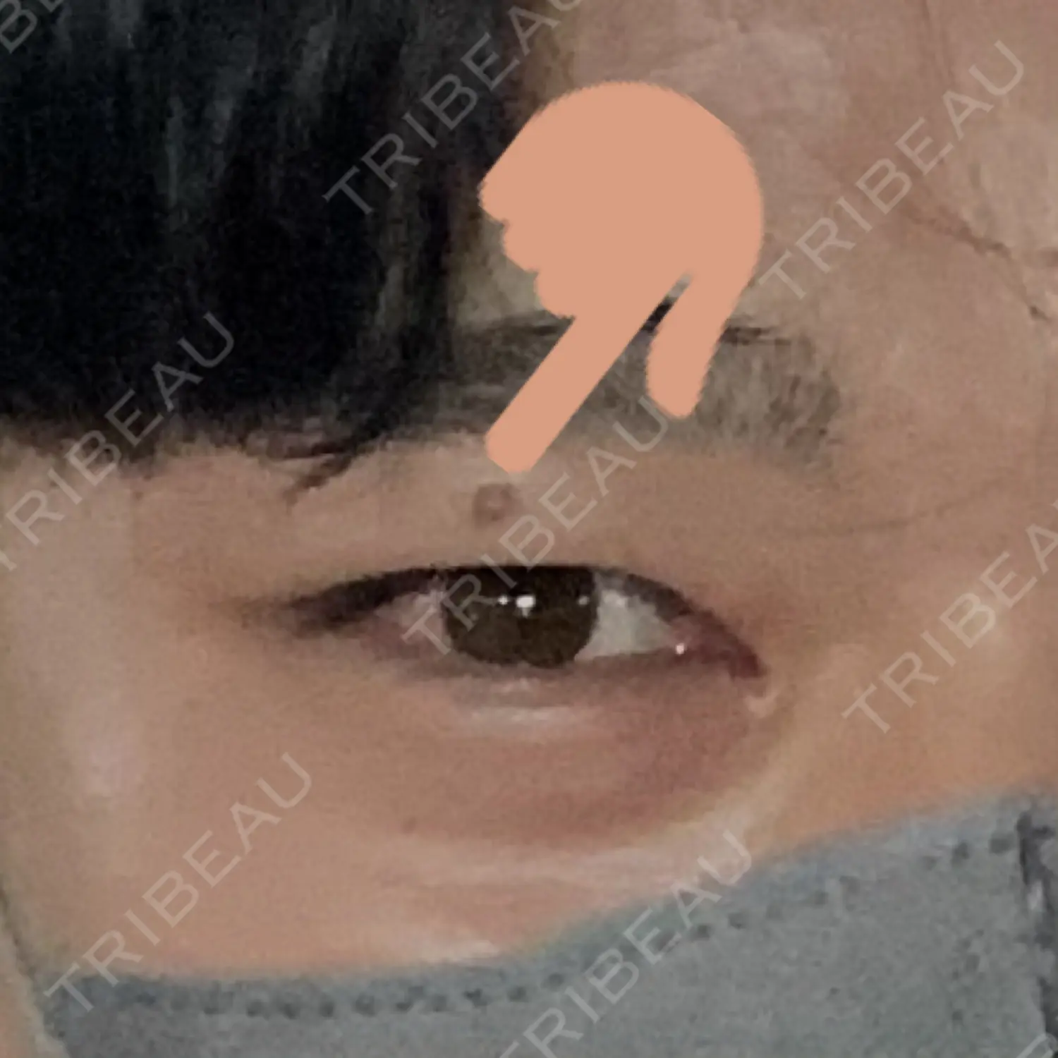 施術前の写真