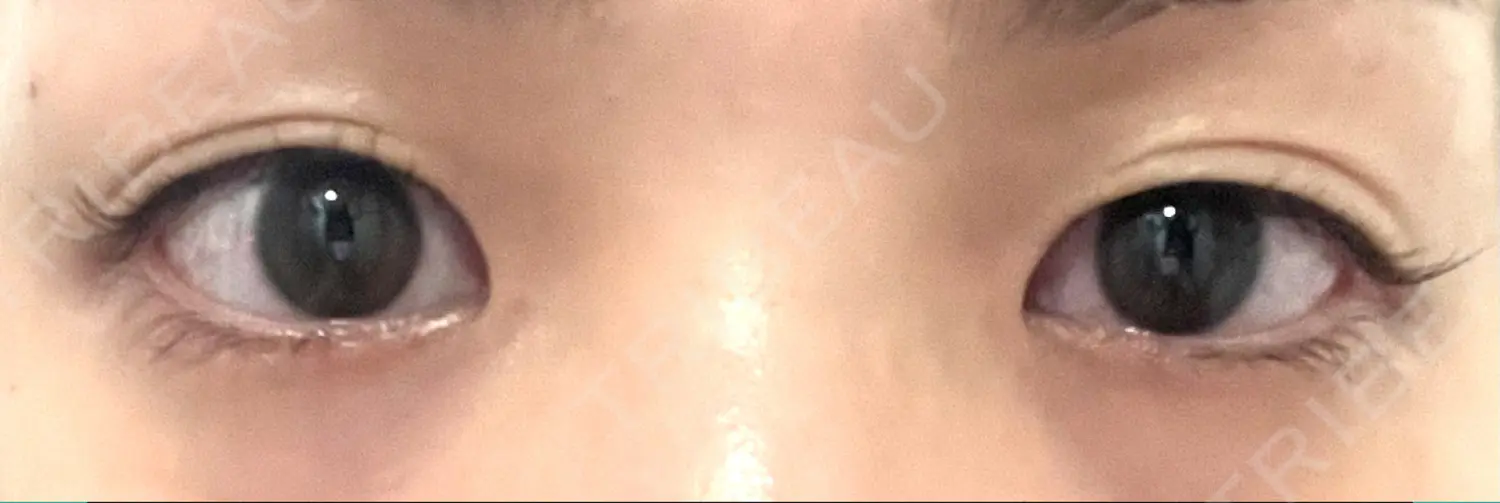 施術前の写真