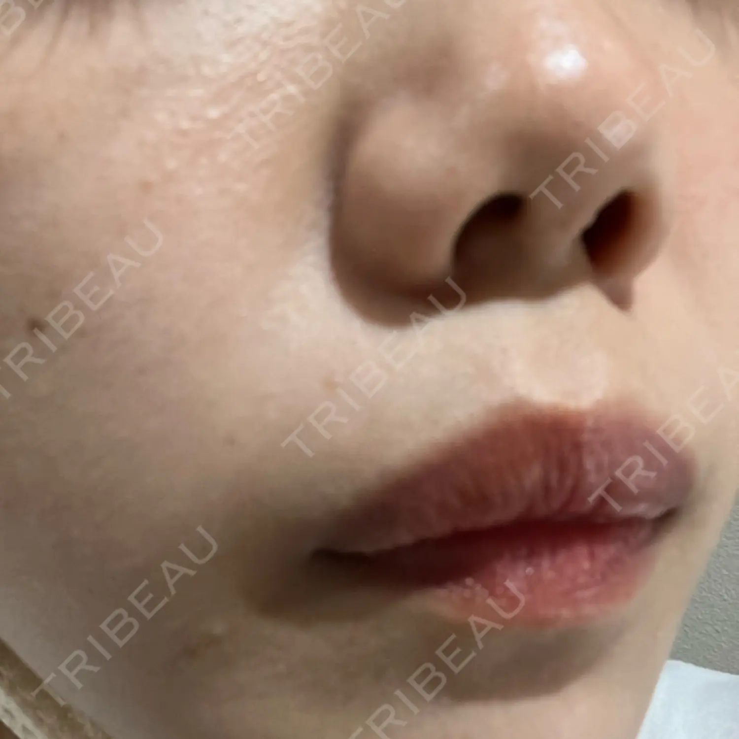 施術前の写真
