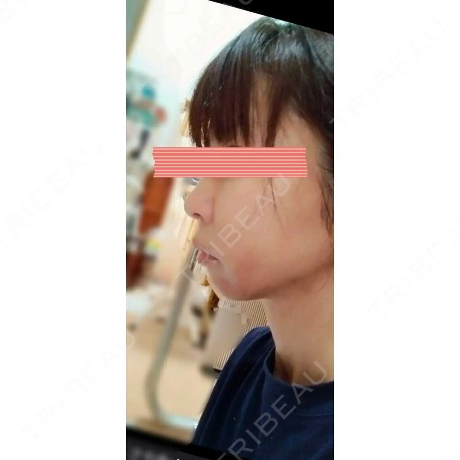 施術前の写真