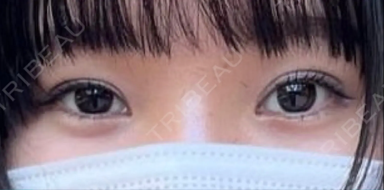 施術前の写真