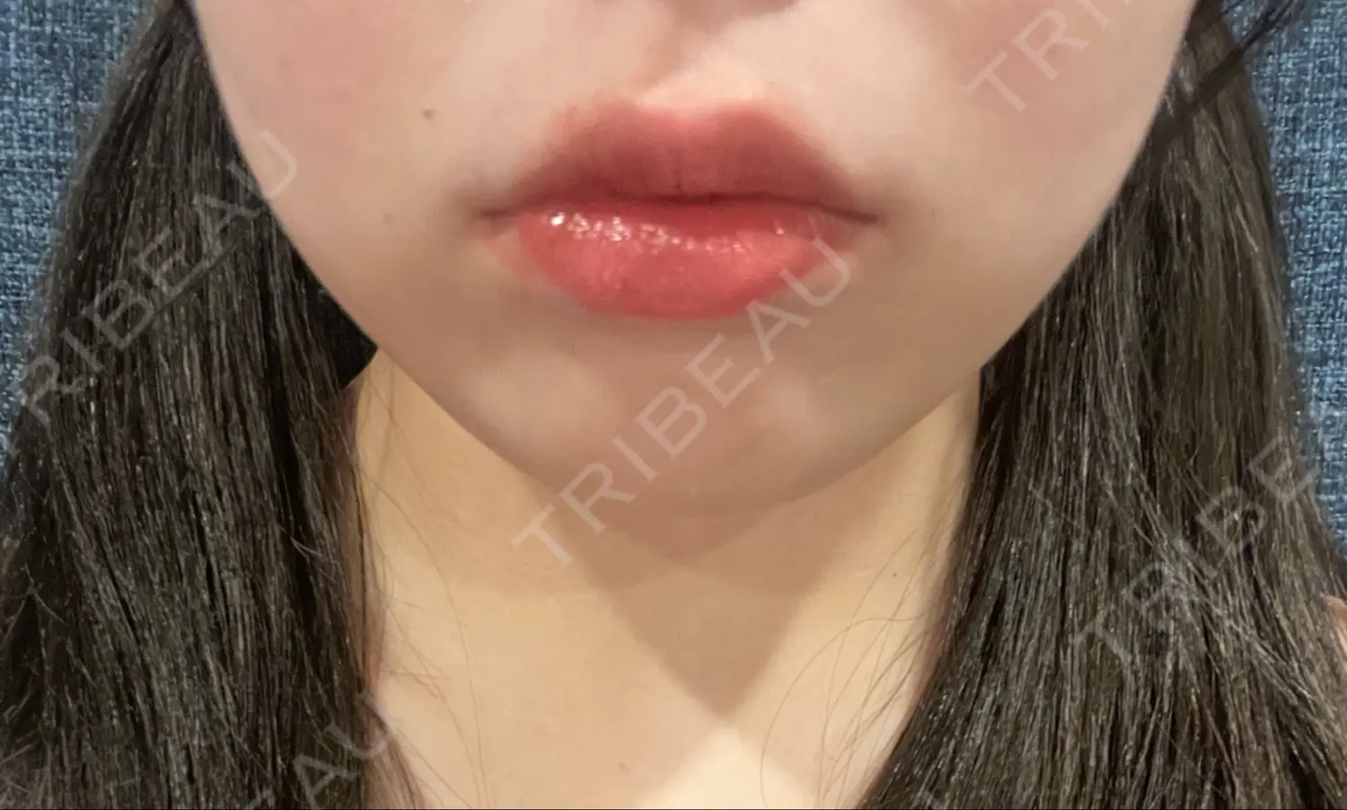 施術前の写真