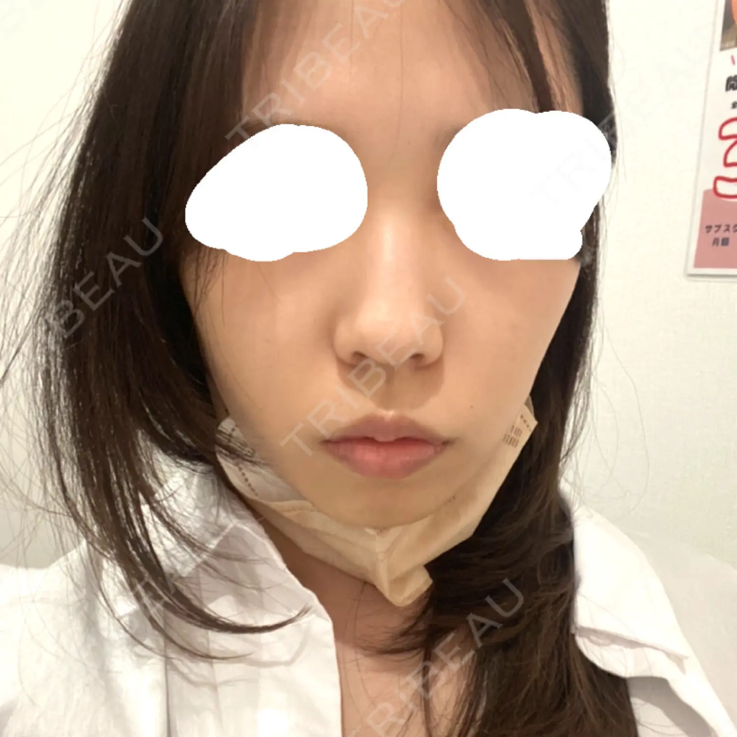 施術前の写真