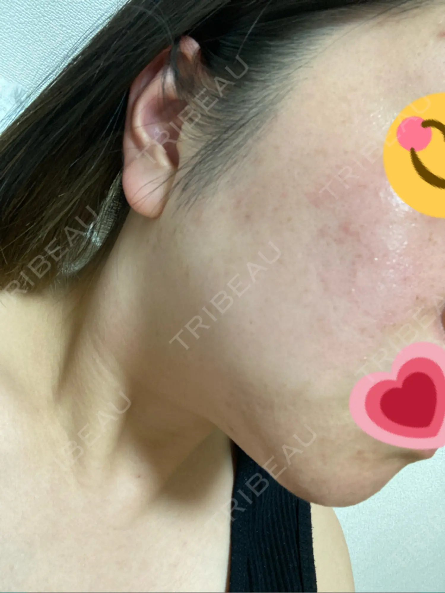 施術前の写真