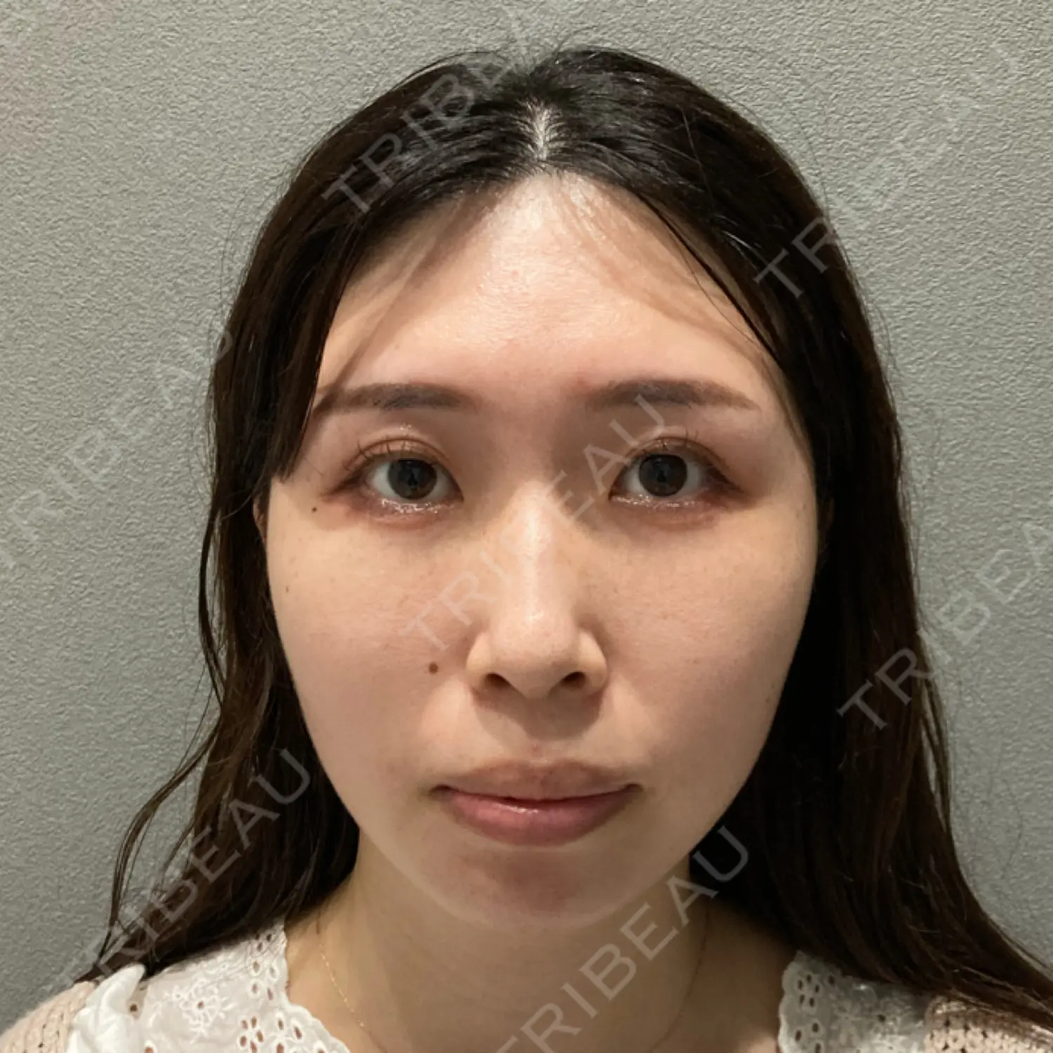 施術前の写真
