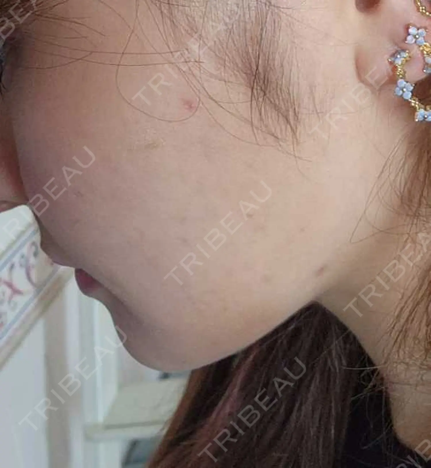 施術前の写真