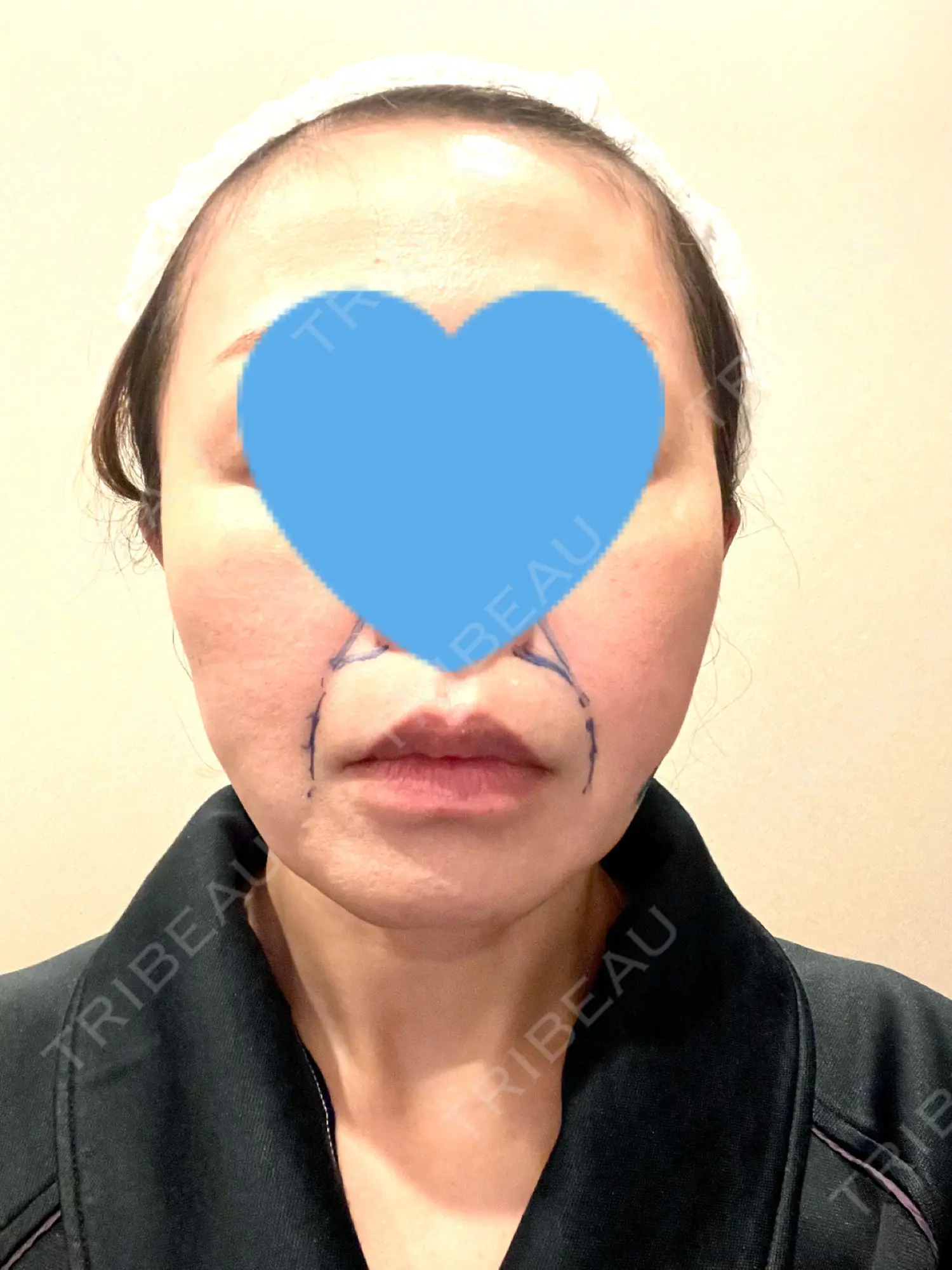 施術前の写真