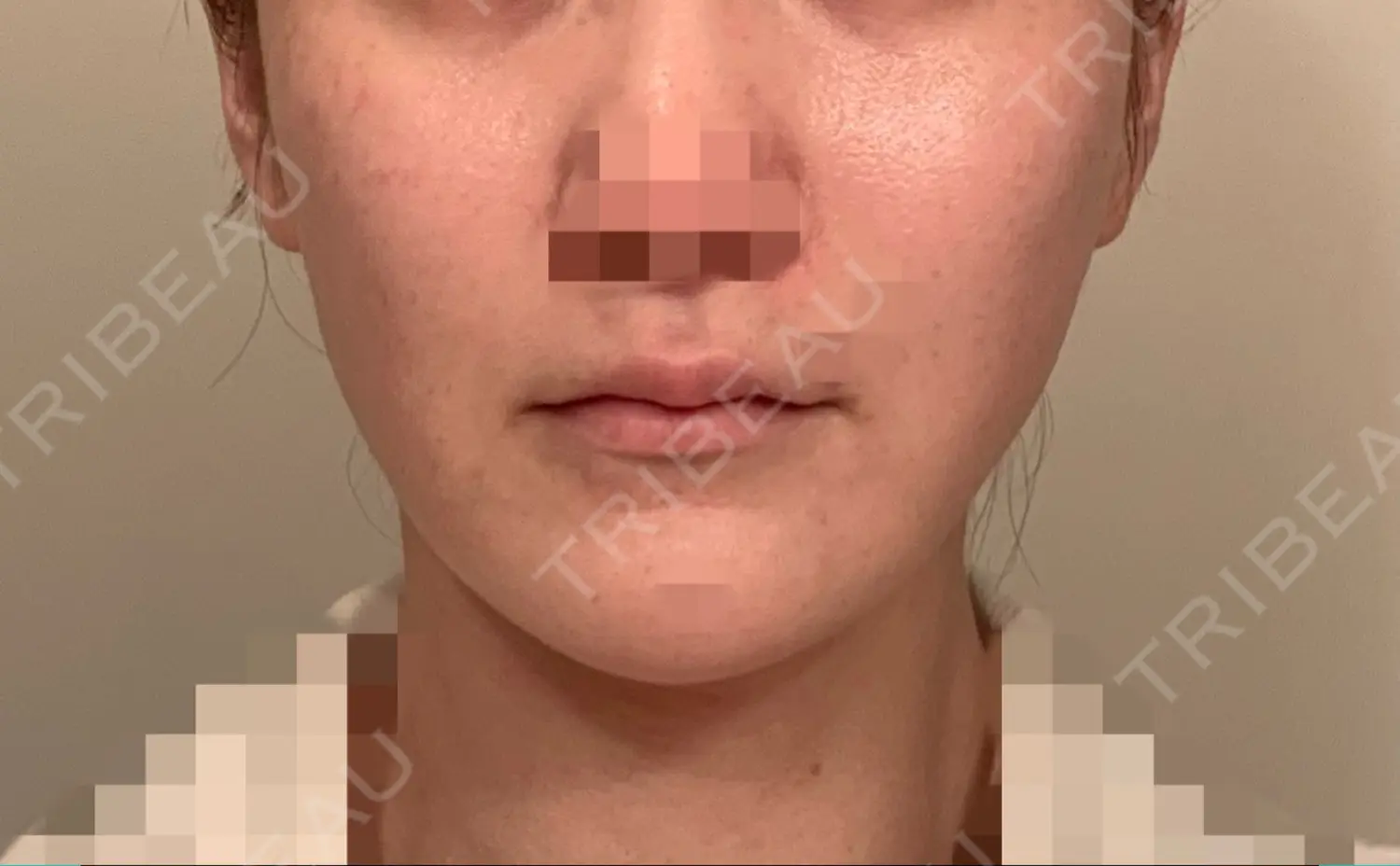 施術前の写真