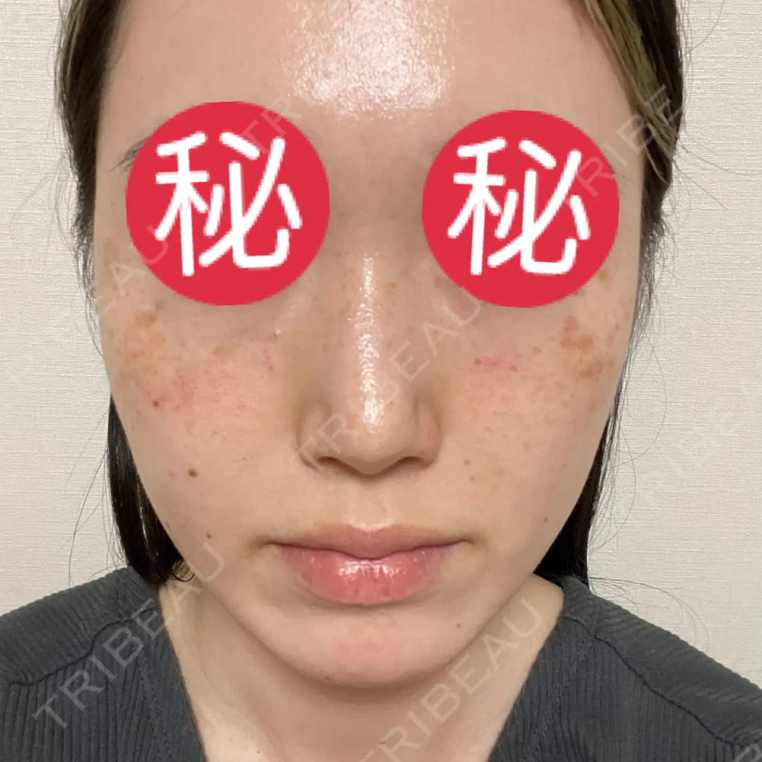 施術前の写真