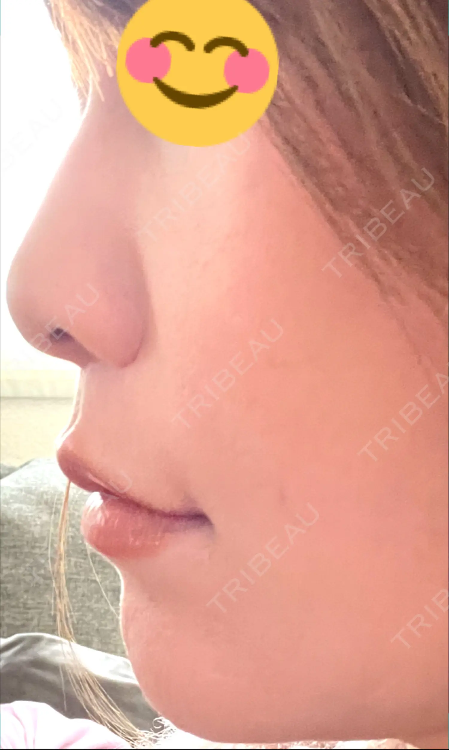 施術前の写真