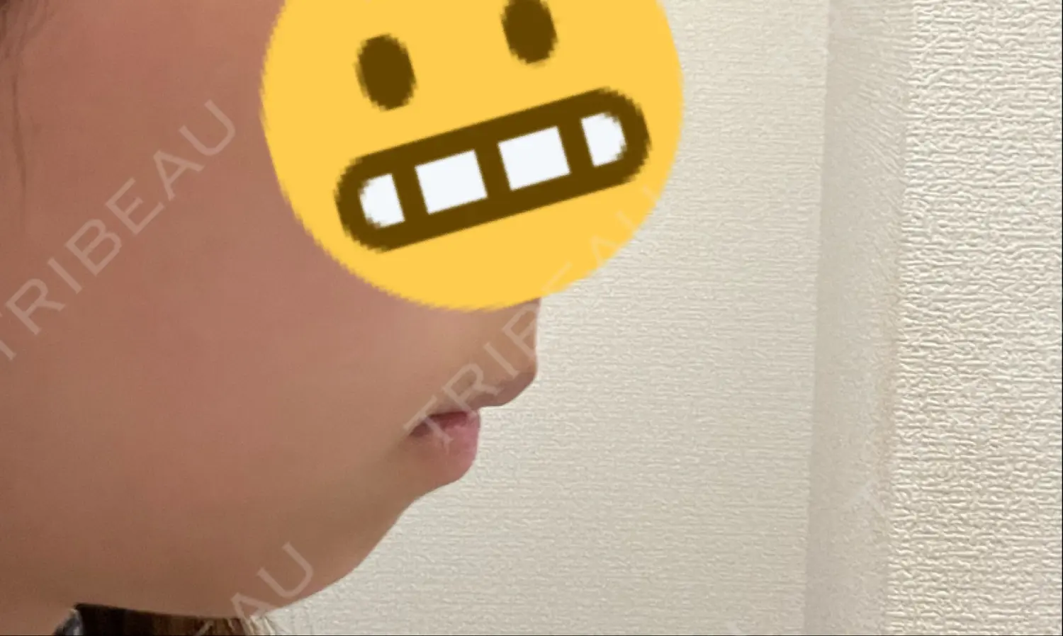 施術前の写真