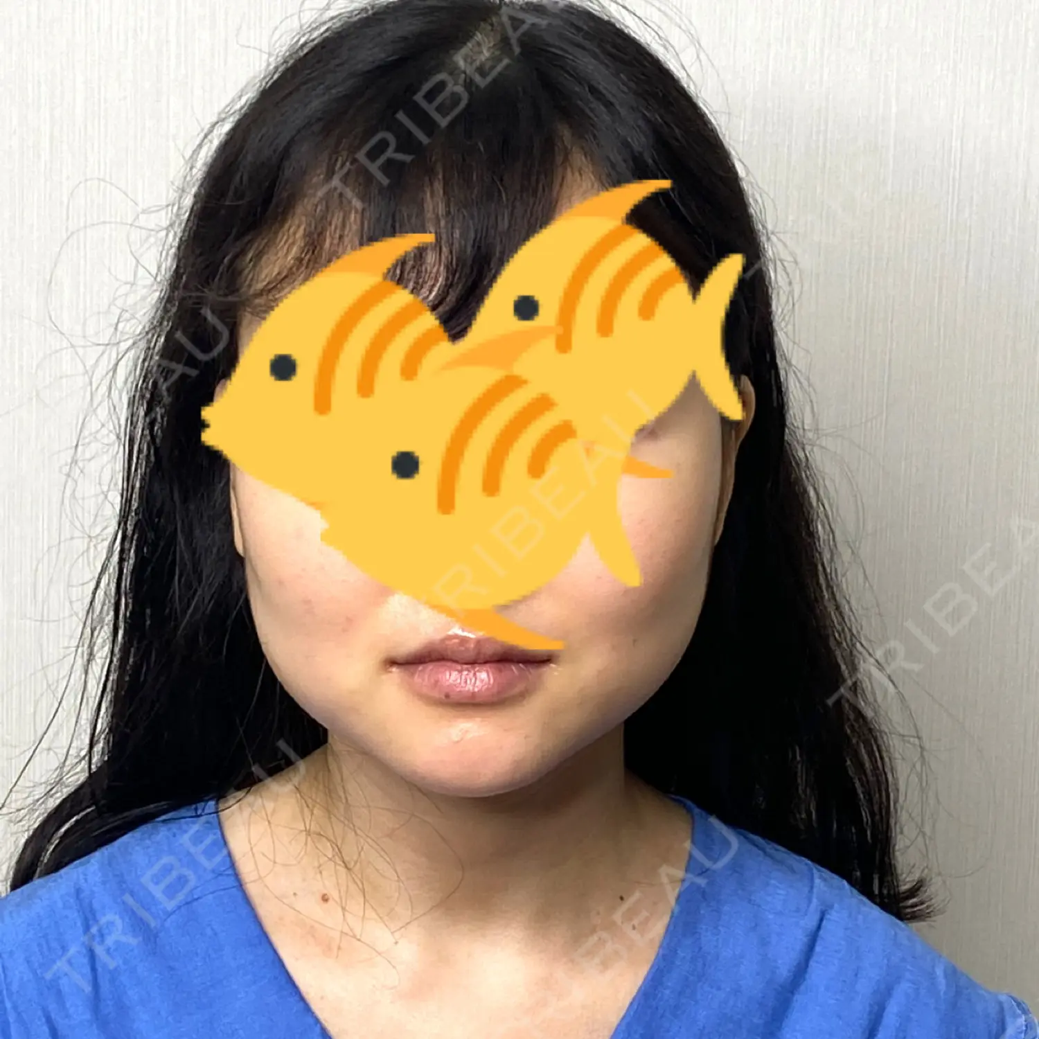 施術前の写真