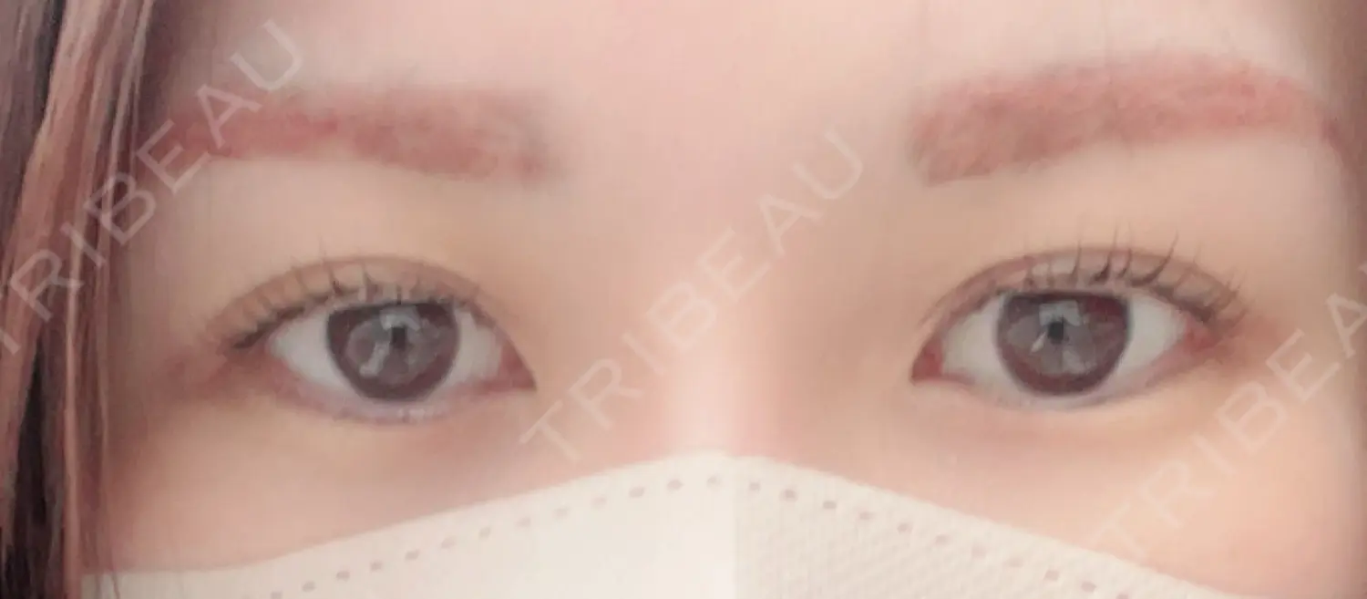 施術前の写真