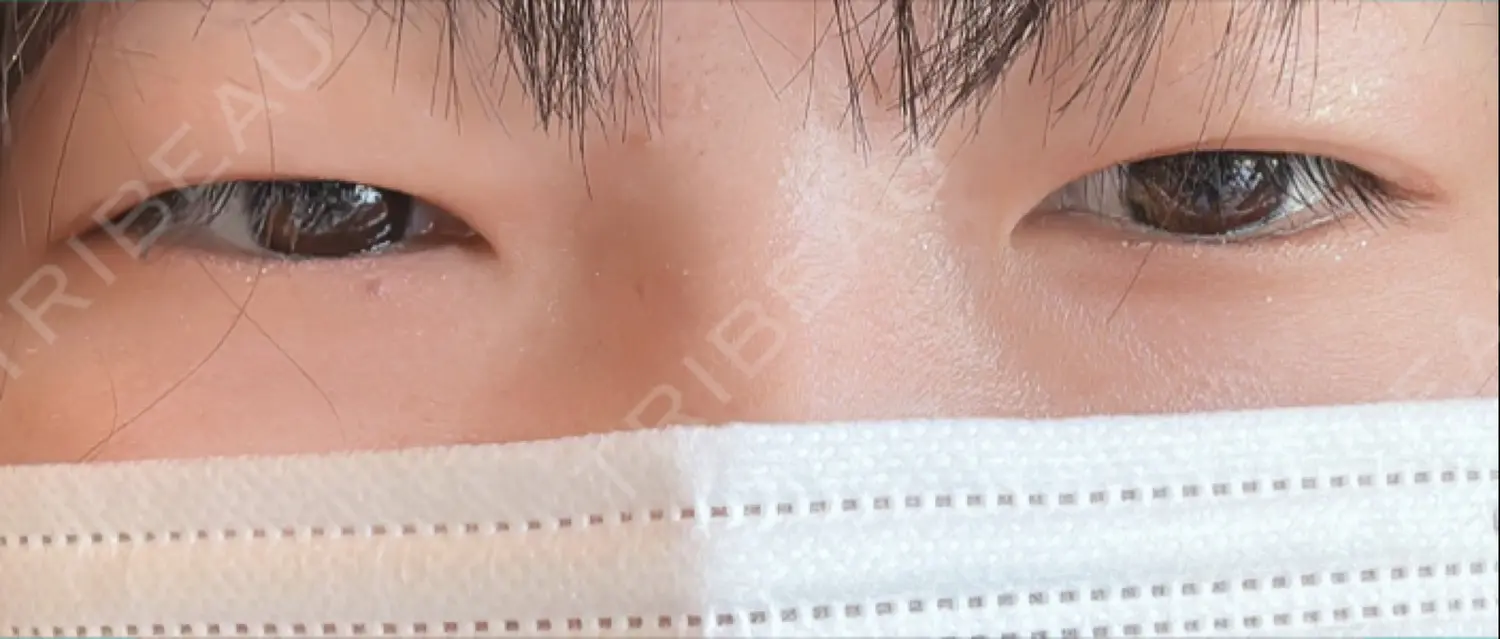施術前の写真
