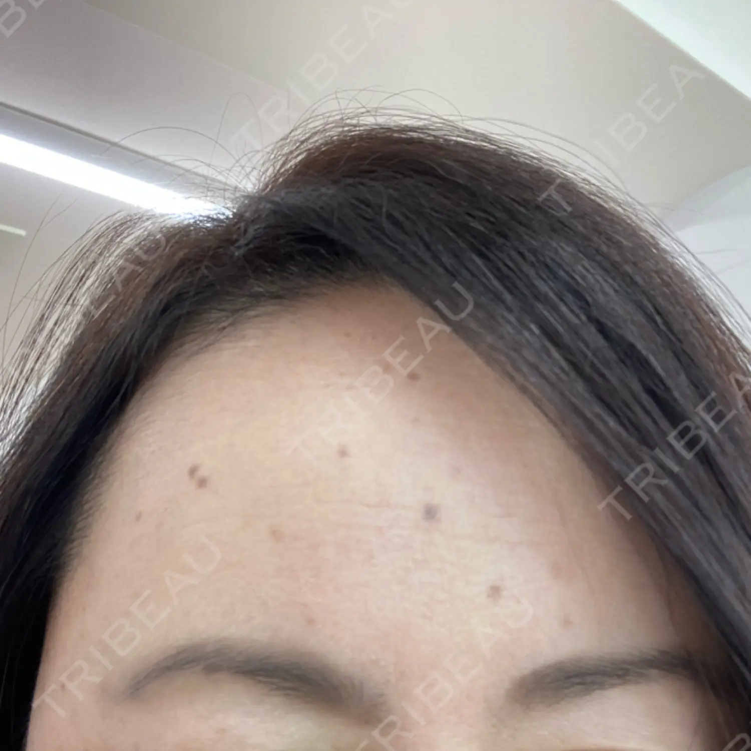 施術前の写真