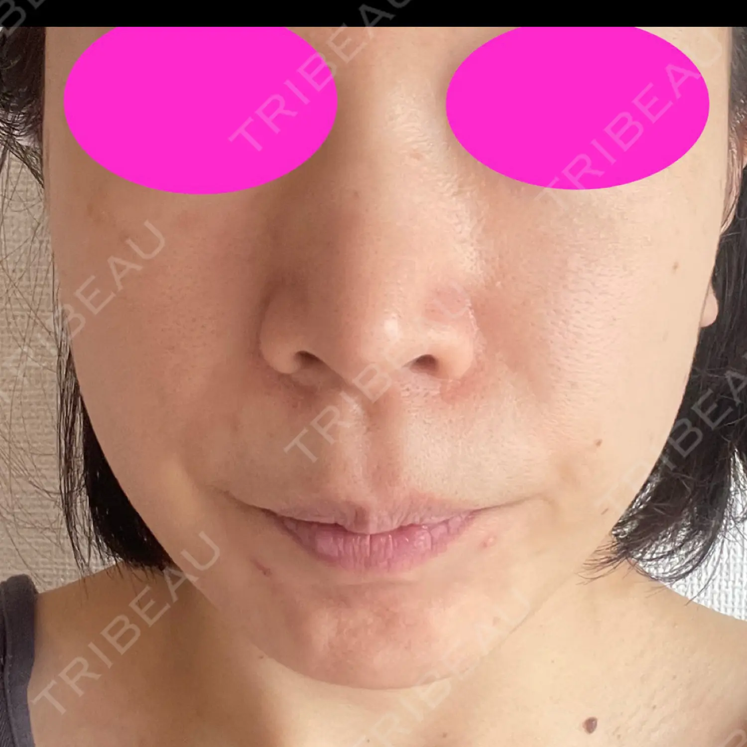 施術前の写真