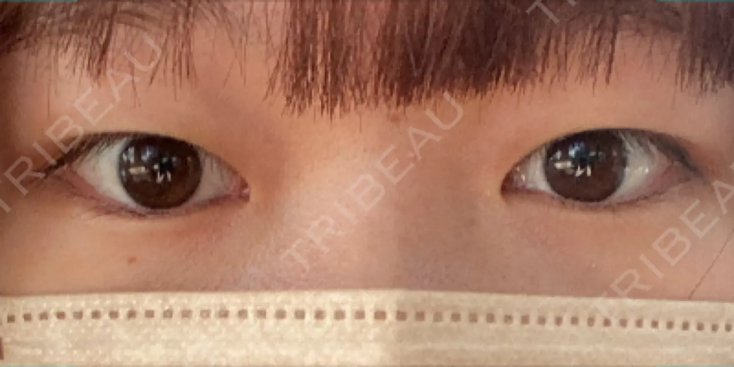 施術前の写真