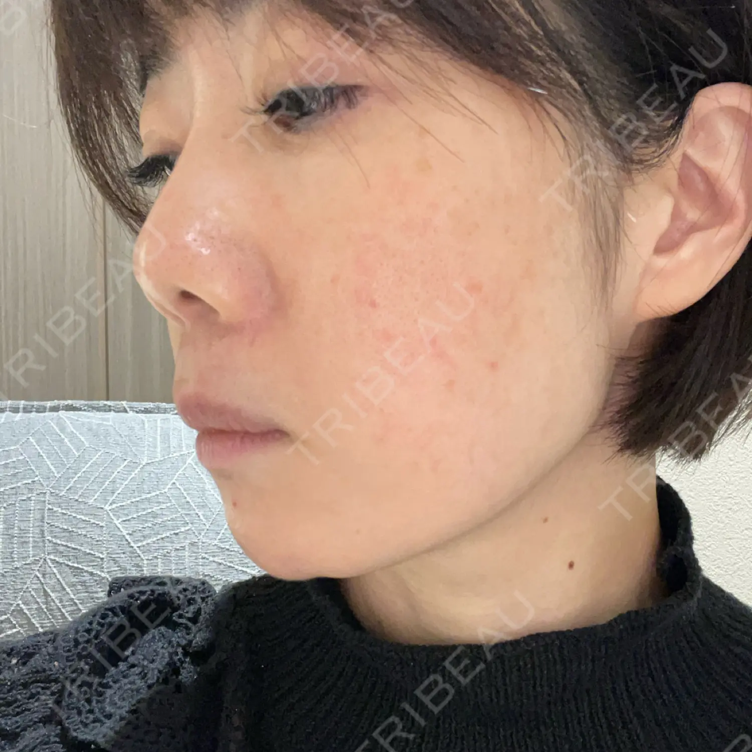 施術前の写真