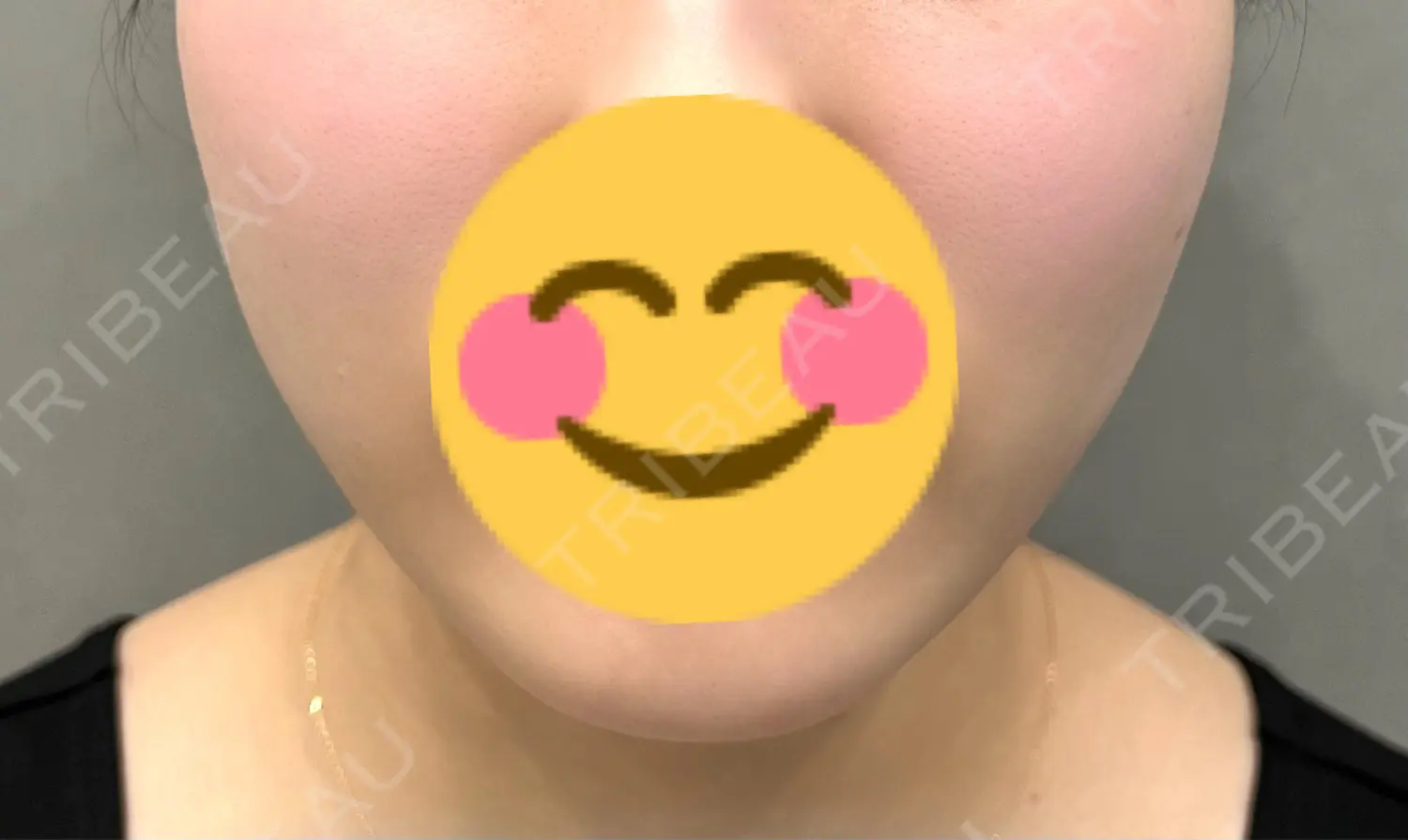施術前の写真