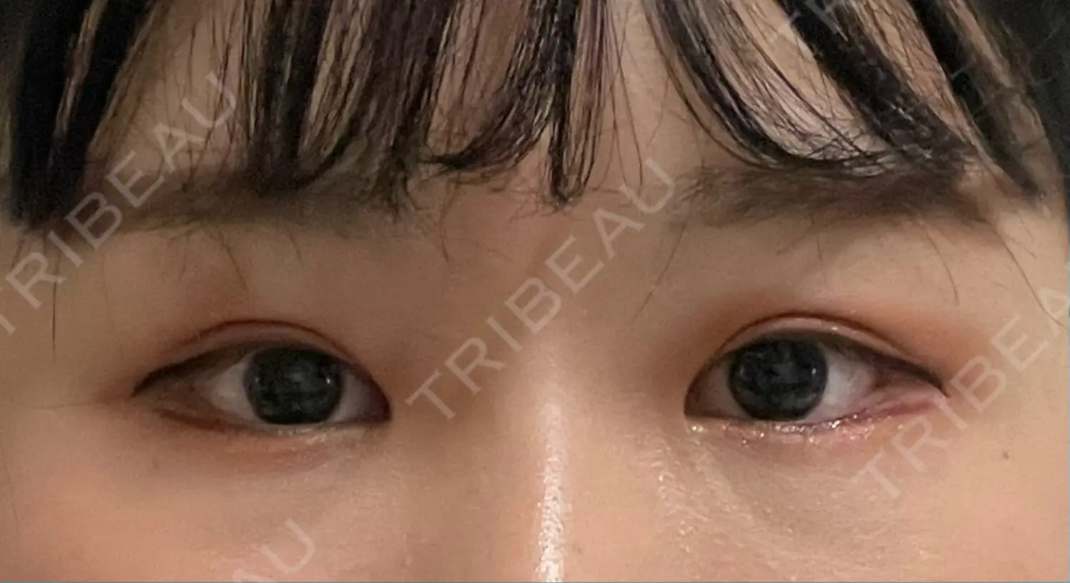 施術前の写真